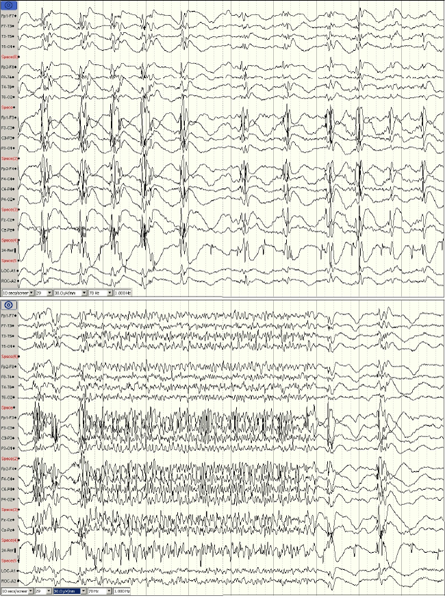 EEG