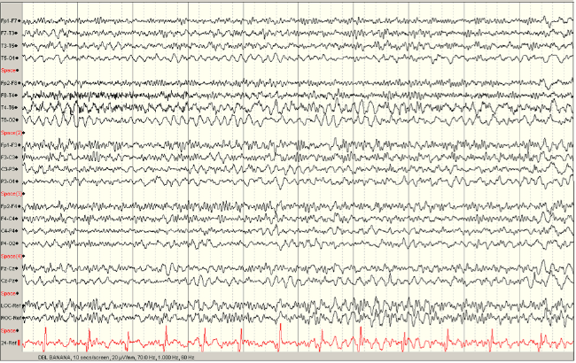 EEG