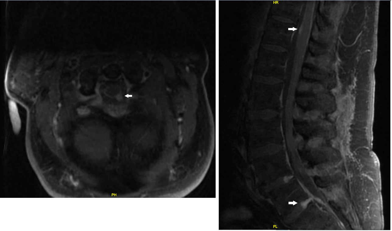 cervical