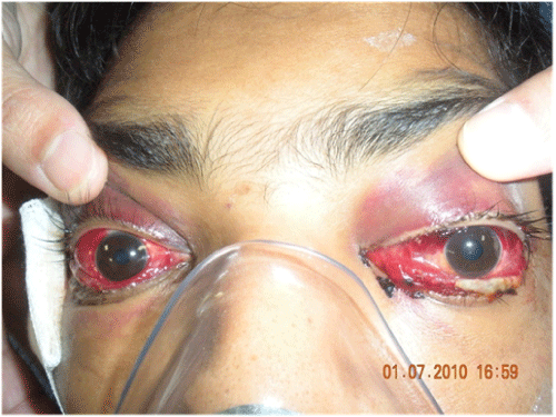 Bloody Discharge From Eye Dog Bloody Discharge From Eye Dog