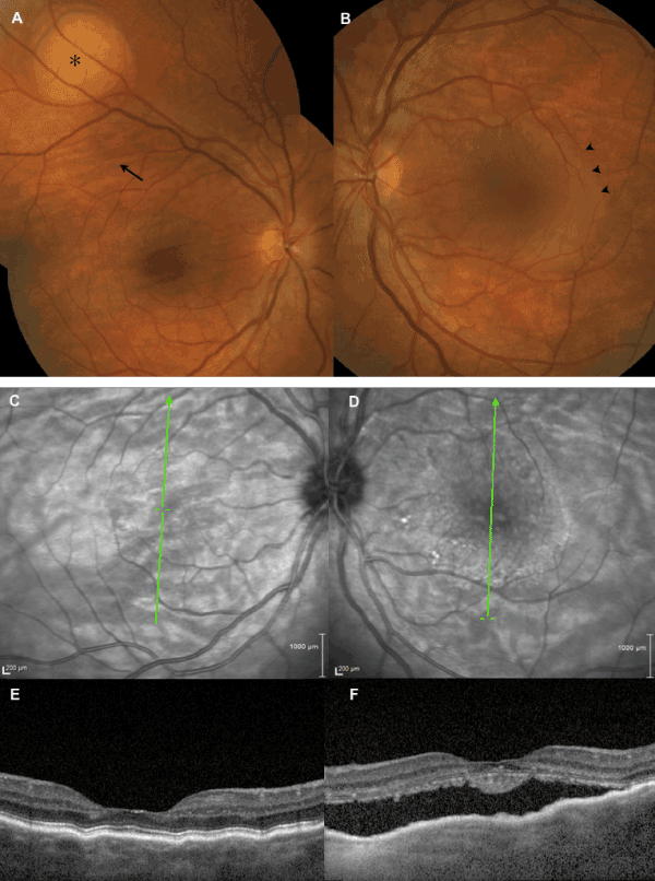 Choroidal Folds Oct Choroidal Folds Oct