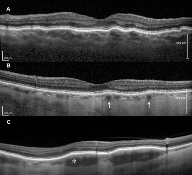 Spectral Domain Optical Coherence Tomography Characteristics Of Spectral Domain Optical Coherence Tomography Characteristics Of
