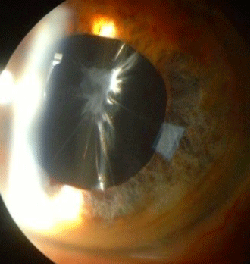 phimosis