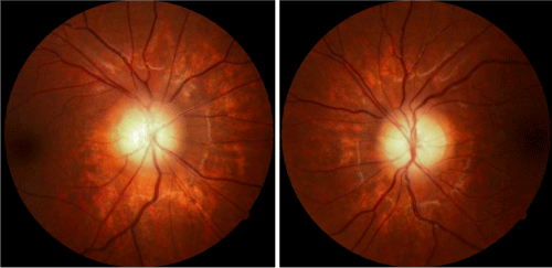 Bilateral