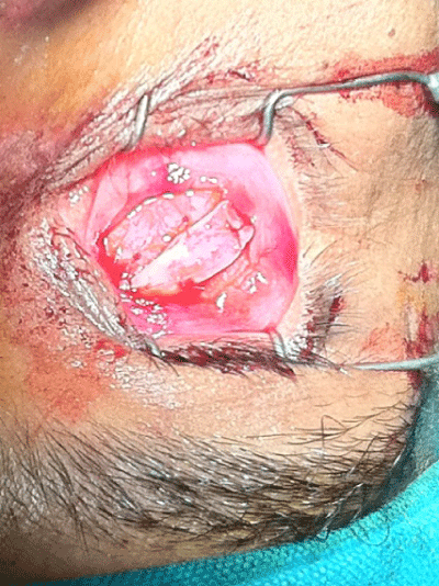 excision