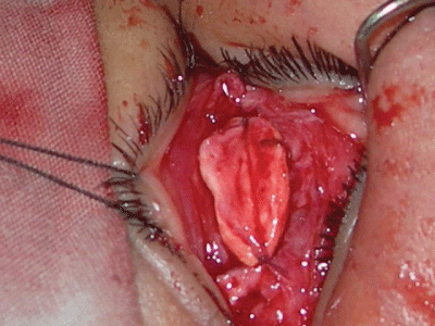 suture lines
