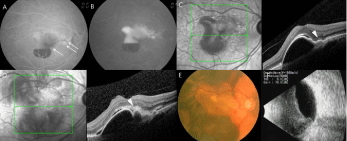 Ophthalmic