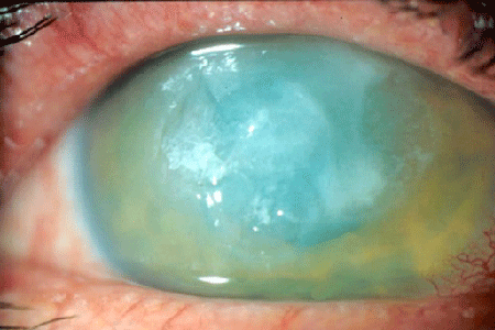 abscess