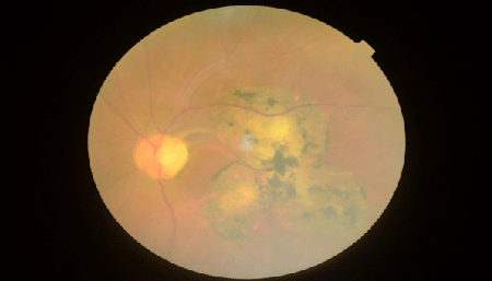 icd 10 cm code for scar epilepsy