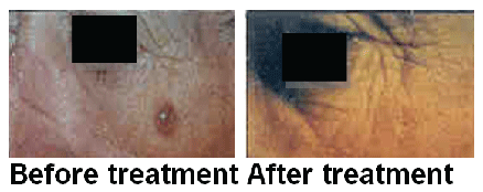 nodular