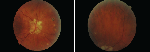fundus