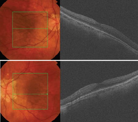 fundus