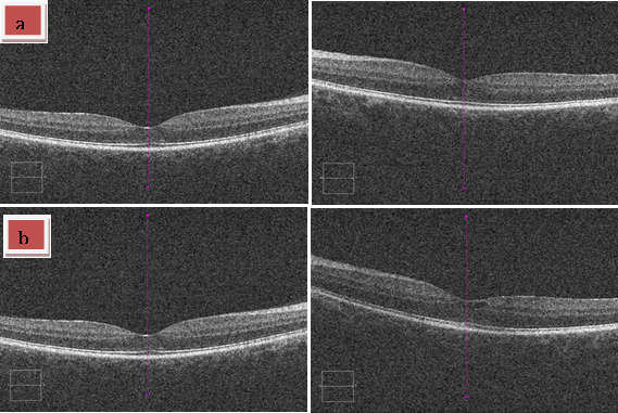 Macular