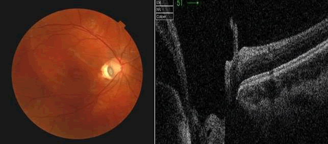 maculopathy