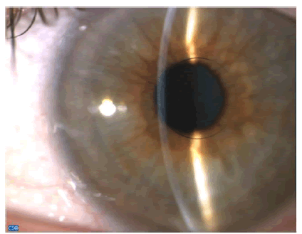 Corneal inlays