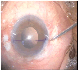 sclerotomy