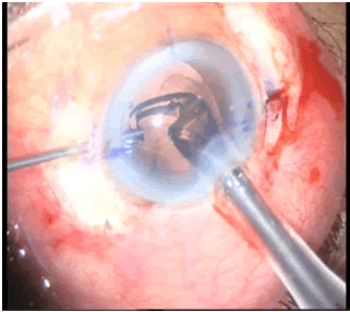 injection