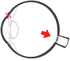 apertures