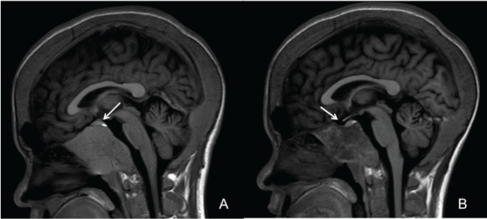 brain