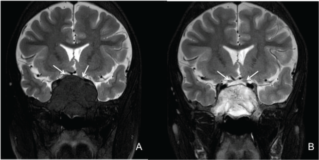 Coronal