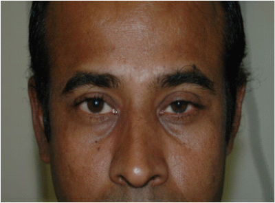multiple myeloma presenting as unilateral proptosis a case report proptosis