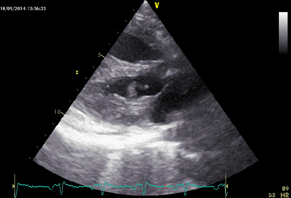 Echocardiography