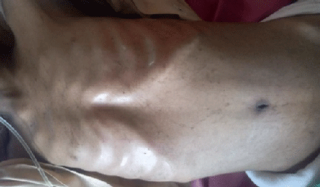erythematous