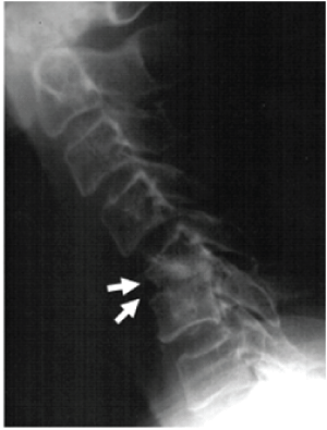 cervical
