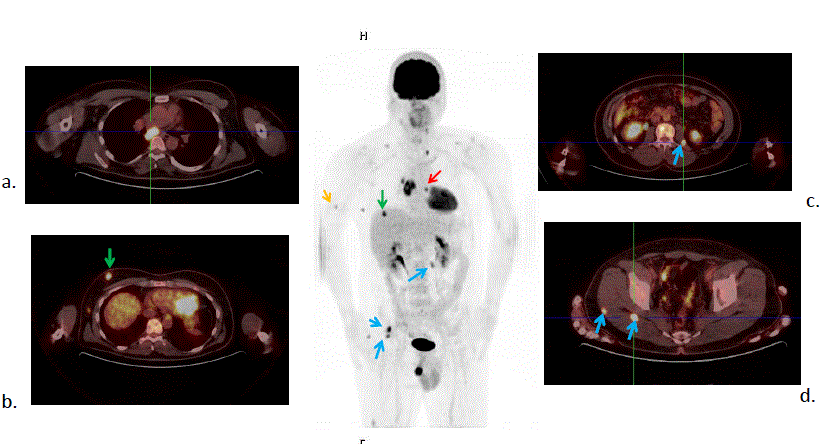 melanoma