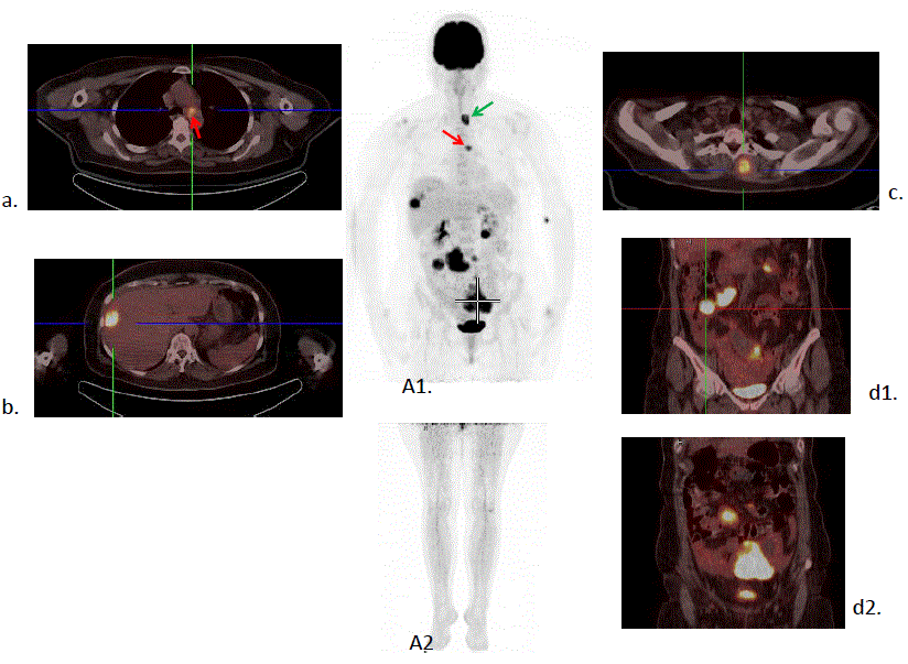 melanoma