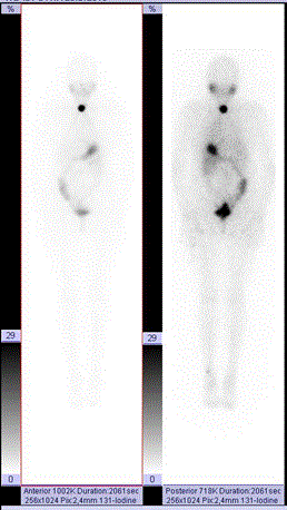 metastases