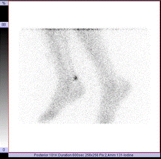 metastases