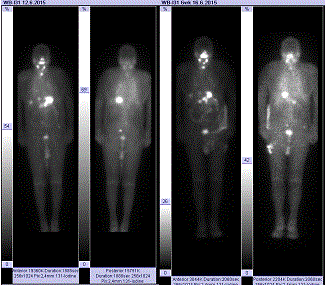 metastases