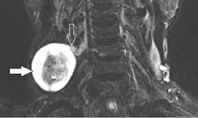 schwannoma