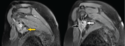 carcinoma
