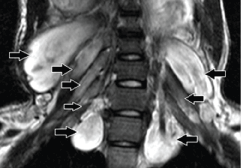 neurofibromatosis