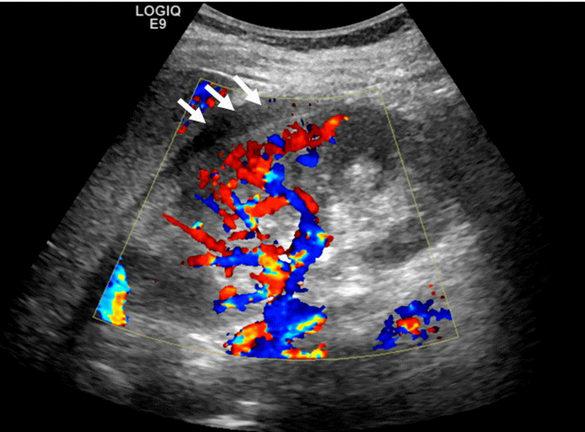 embolization