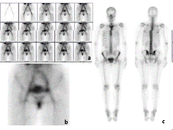 scintigraphy