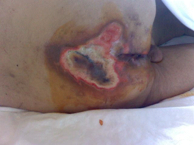 Decubitus