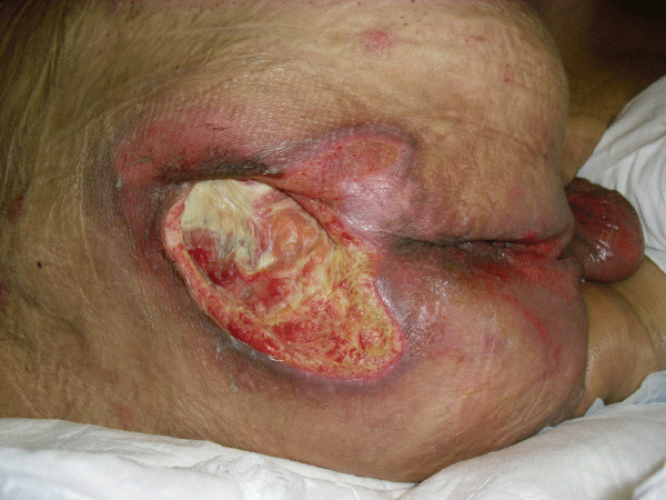 ulcer