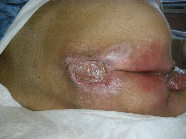 ulcer