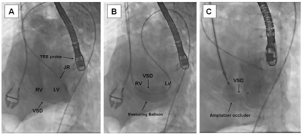 Fluoroscopic