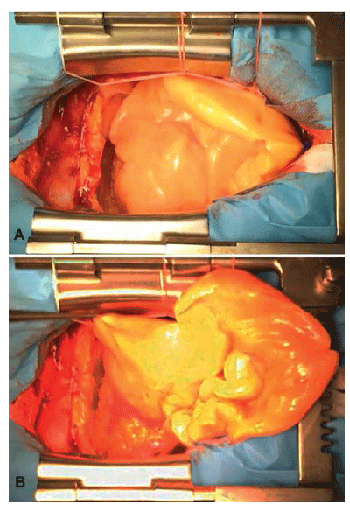 Intraoperative