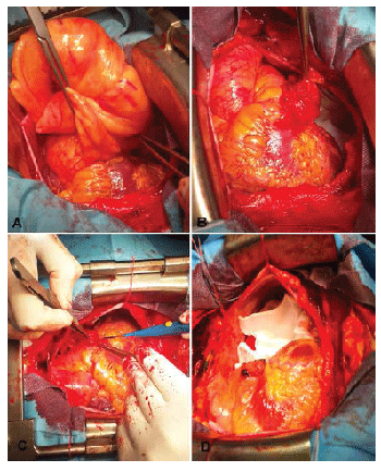 Intraoperative
