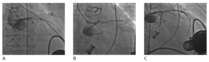 Coronary angiography