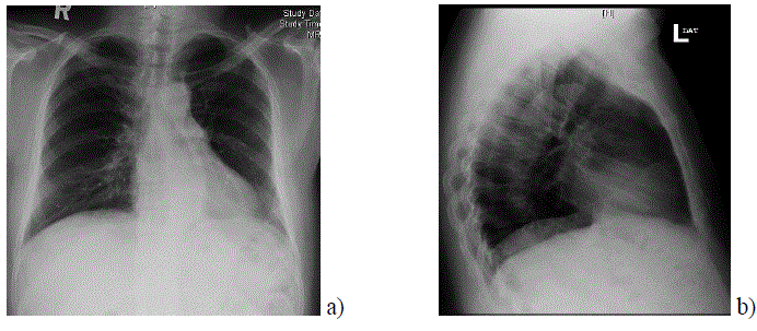CXR