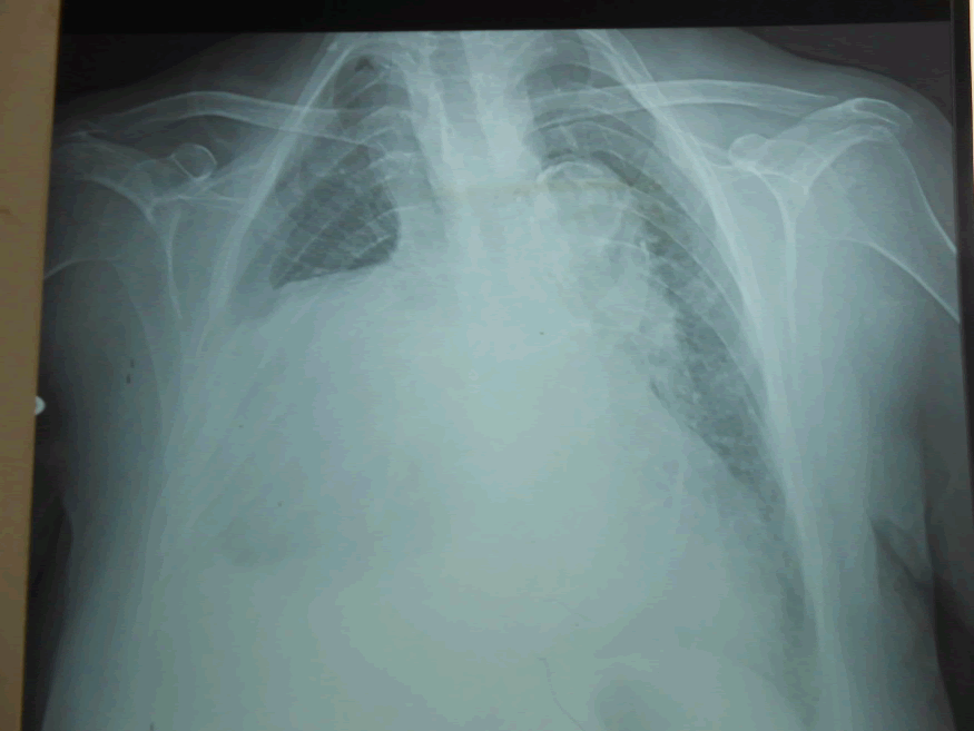 Mediastinal