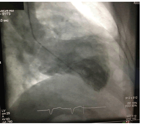 ventriculogram