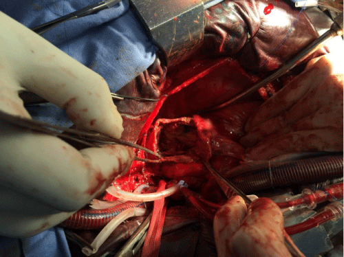 Intraoperative