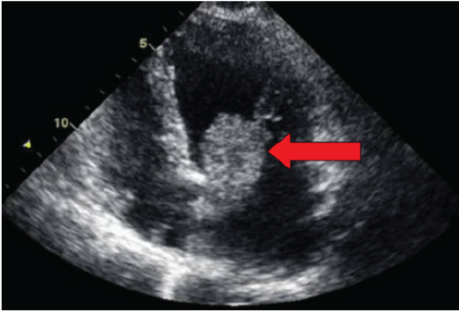 transthoracic